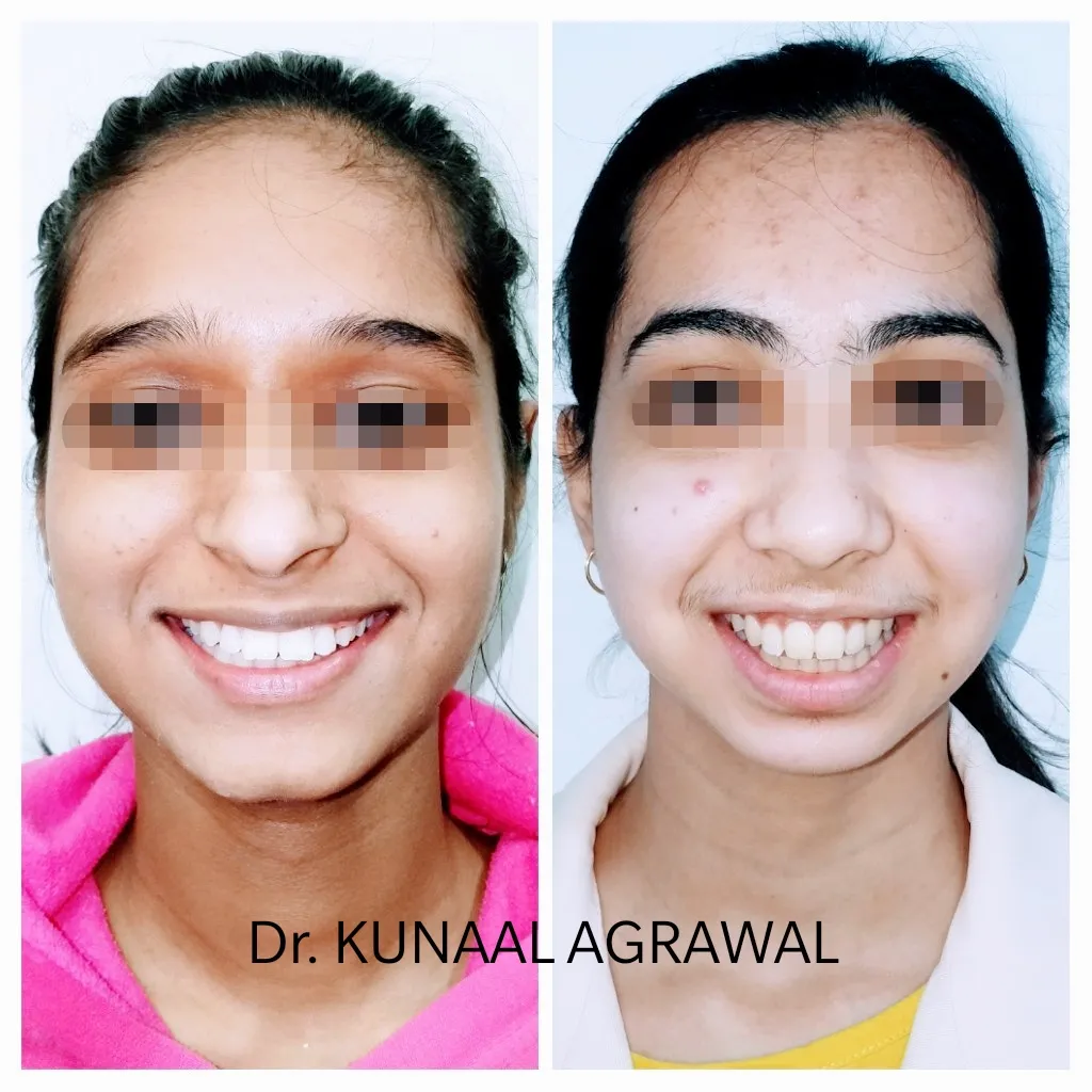 braces before and after bhopal 6